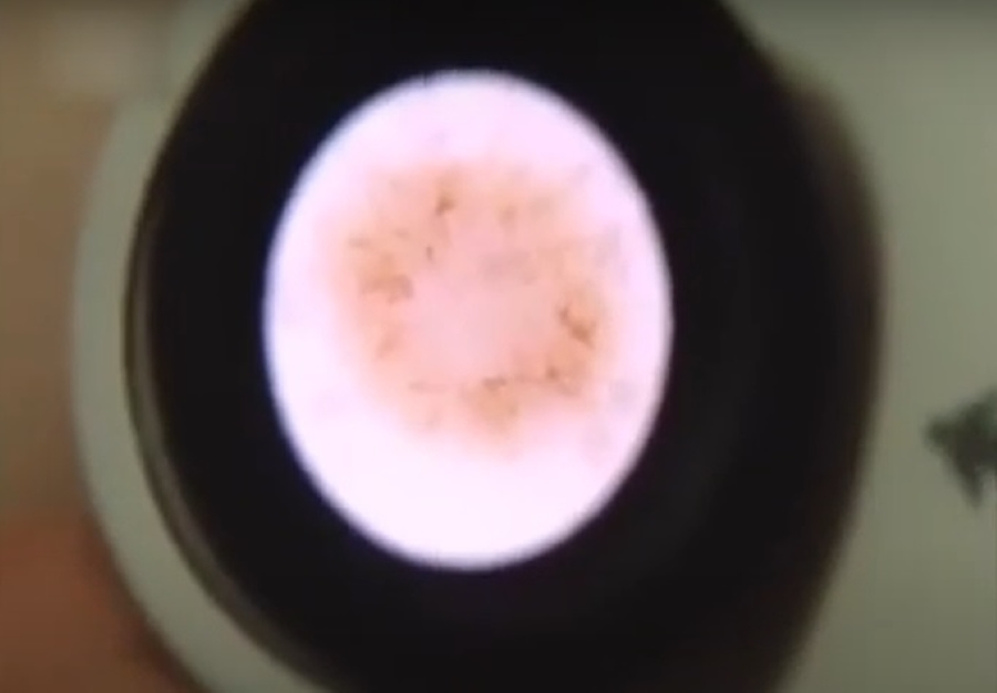 Identifican varias proteínas implicadas en la progresión del melanoma